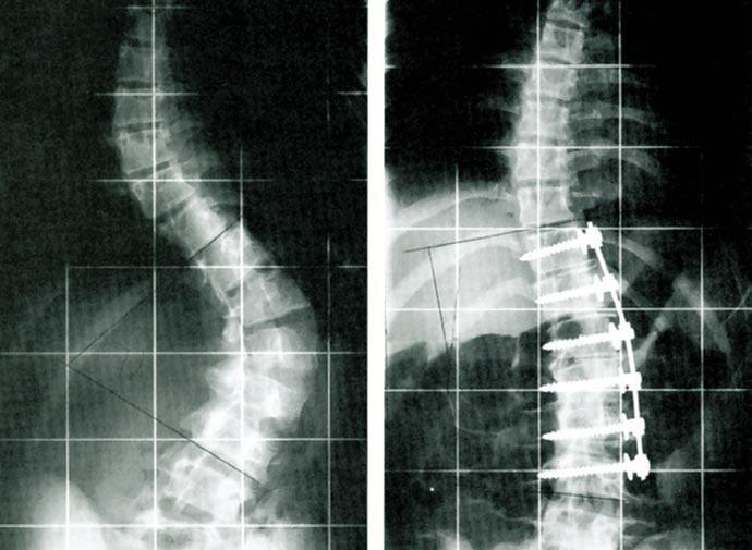 Spondylodese Wirbelsäulenstabilisierung APEX Spine Spondylodese Wirbelsäulenstabilisierung APEX Spine