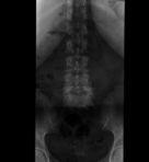 Spondylolisthese