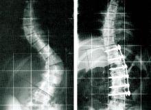 spondylodese