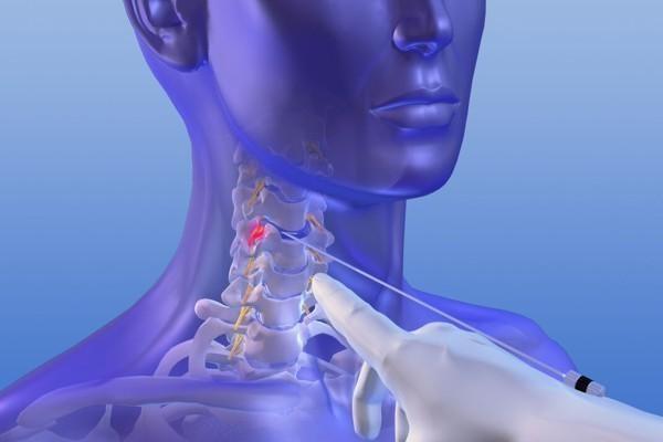 Bandscheiben Op Apex Spine 2020