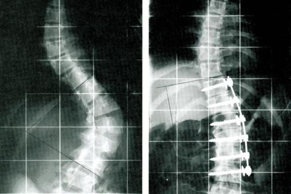 Spondylodese Apex